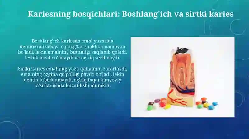 Karies bosqichlari. Boshlangʻich va yuza karies 3