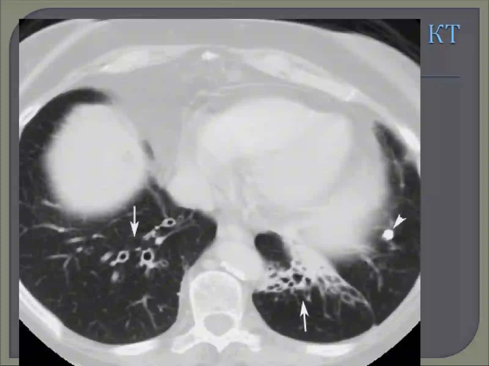 YURAK-QON TOMIRLARI KASALLIKLARIDA KOMPYUTER TOMOGRAFIYANING AXAMIYATI 3