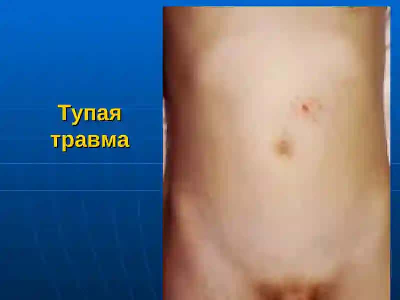 Травма Живота 3