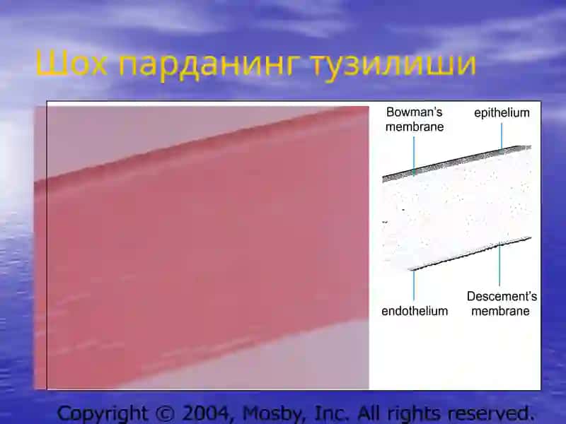 Кератитлар 3