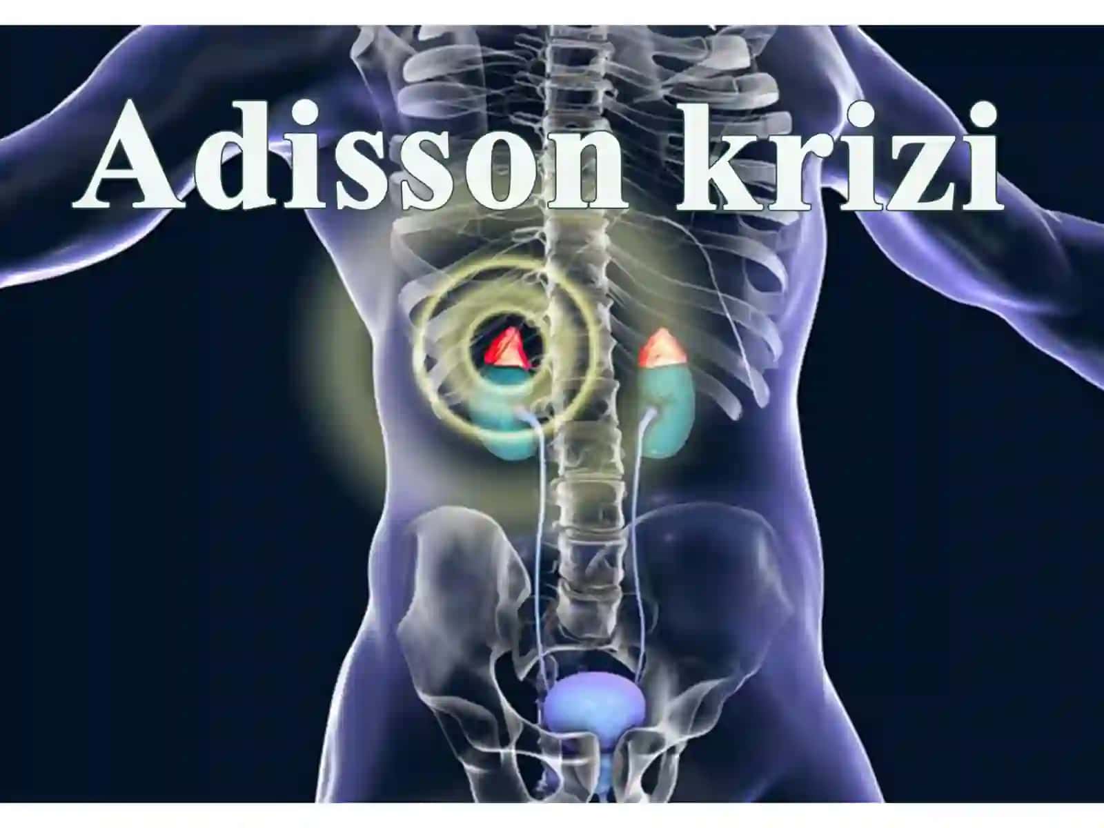 Addisonikkriz 3