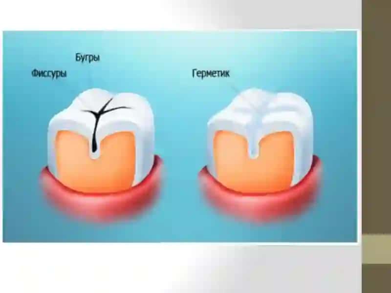 Bolalarda kariyes profilaktikasida fissuralarni muhrlash va ularning ahamiyati. 3