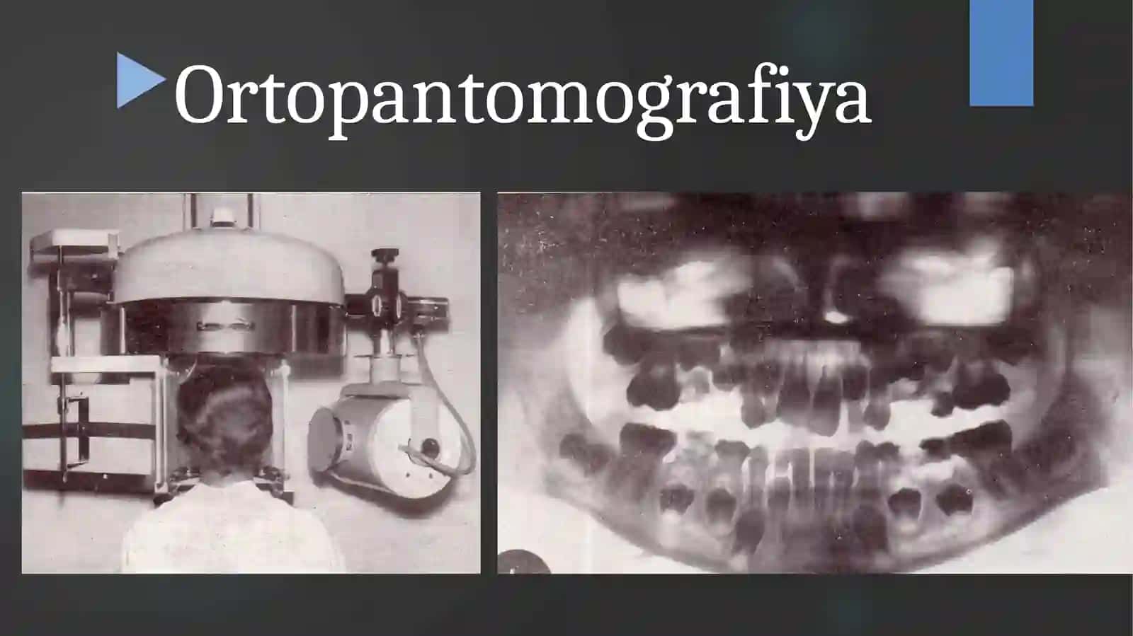 Rengenologik tekshiruv usullari. Ortopantomografiya, tomografiya, 3D va Telerentgenografiya asoslari. 3