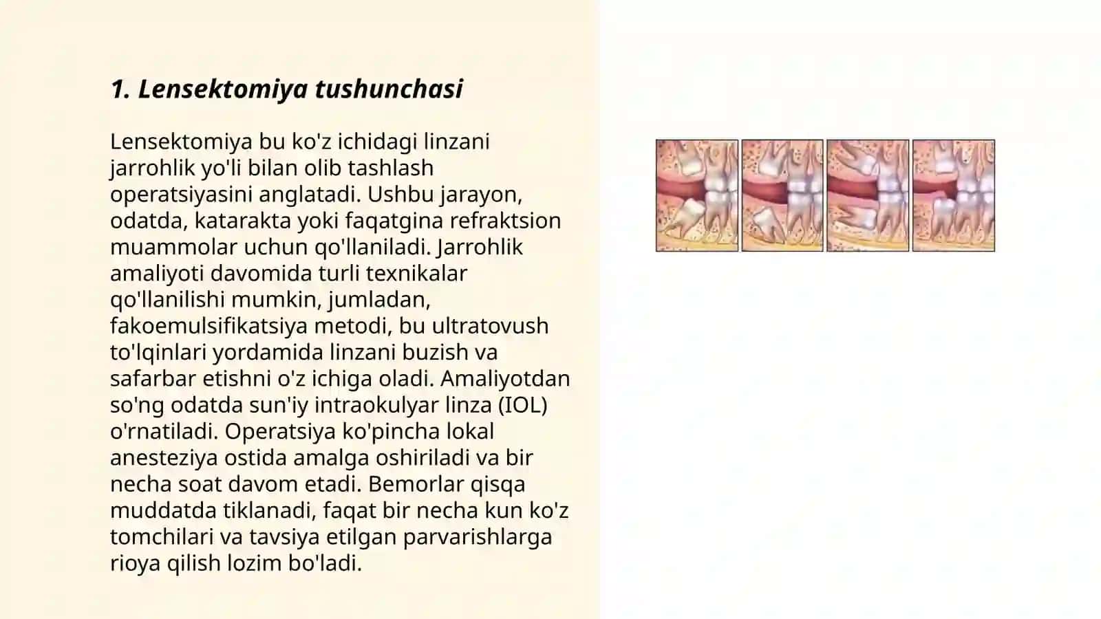 Lensektomiya jarrohlik usuli 3