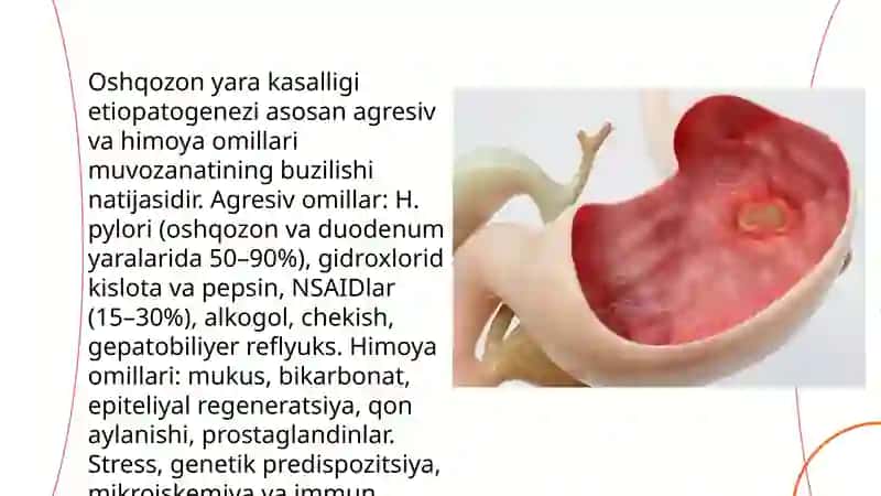 Oshqozon yara kasalligi etiopatogenezi 3