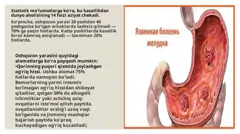 Oshqozon yarasikasalligi :Etiologiyasi va patogenezidagi Zamonaviy aspektlar 3