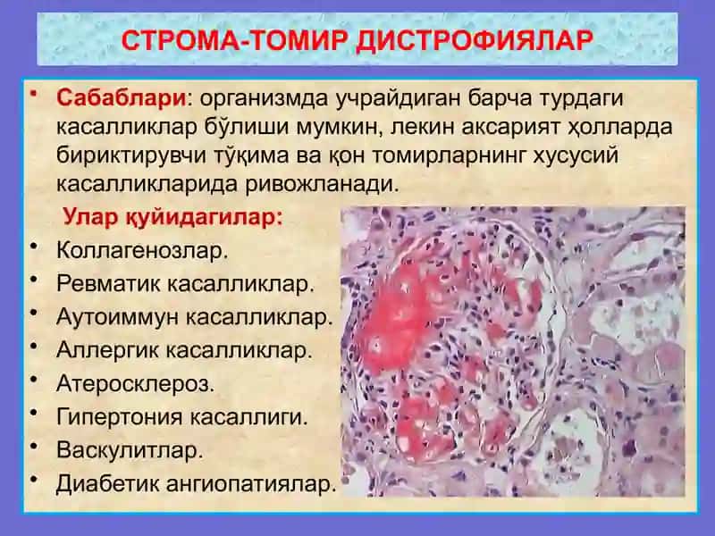 СТРОМА-ТОМИР ДИСТРОФИЯЛАР 3
