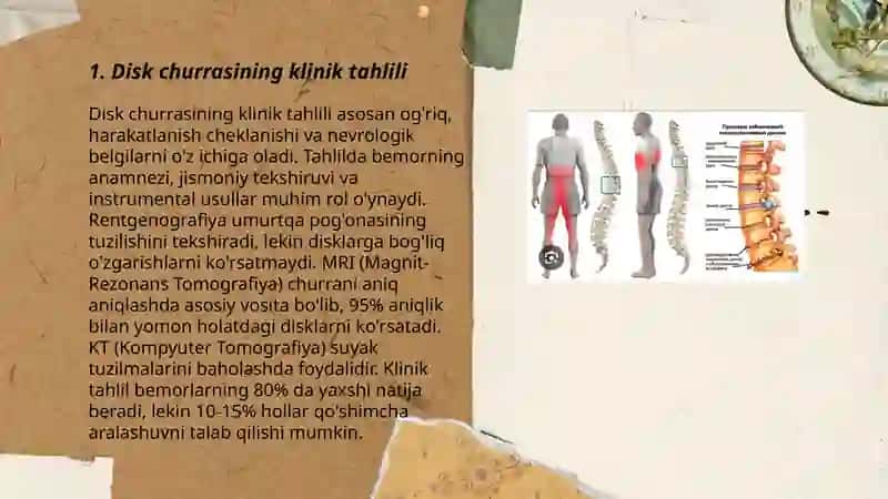 Disk churrasining kelib chiqish sabablari va konservativ davolash 3