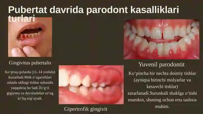 Pubertat yoshida sodir bo'ladigan parodont kasalliklari 3