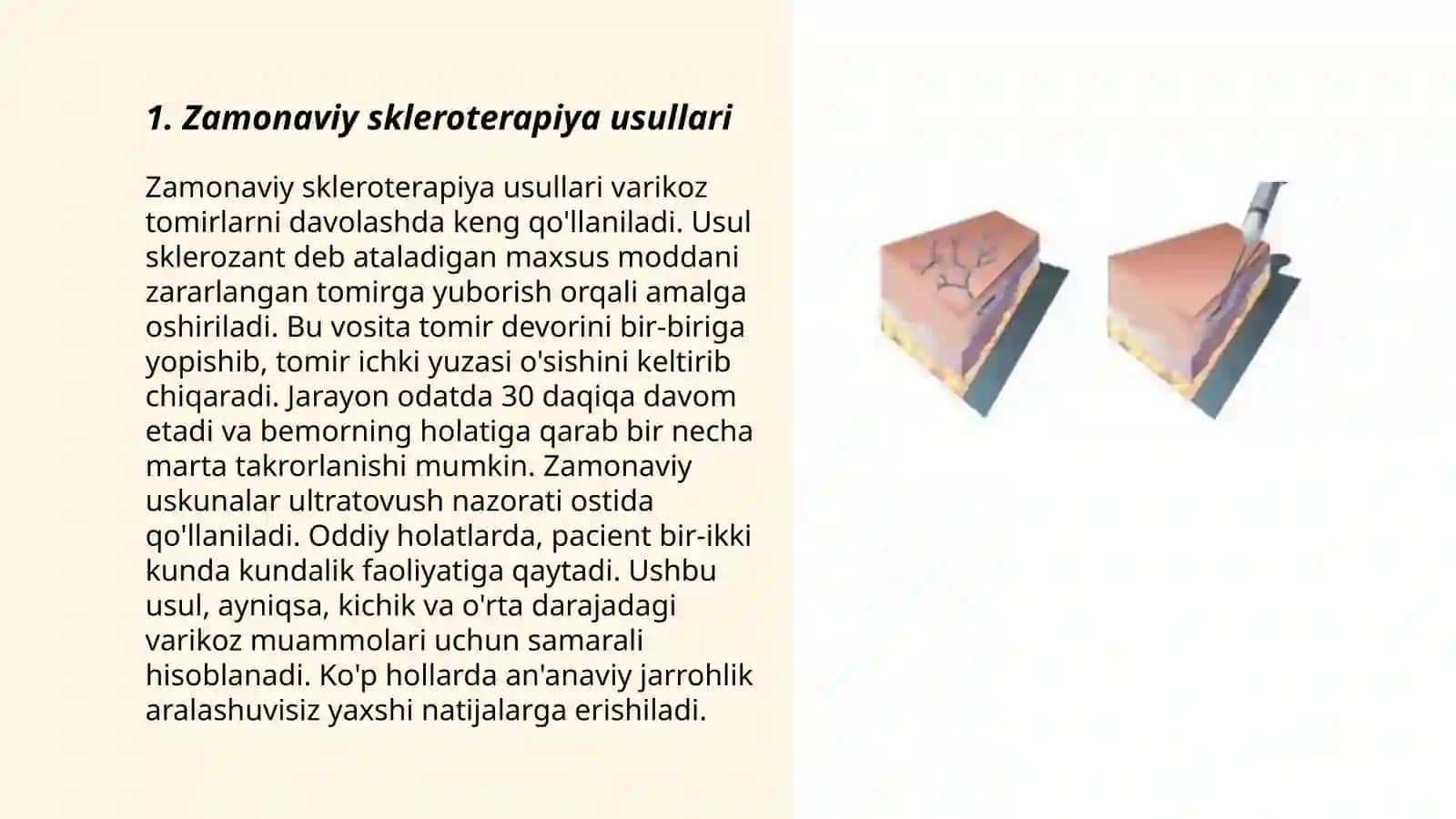 Zamonaviy skleroterapiya 3