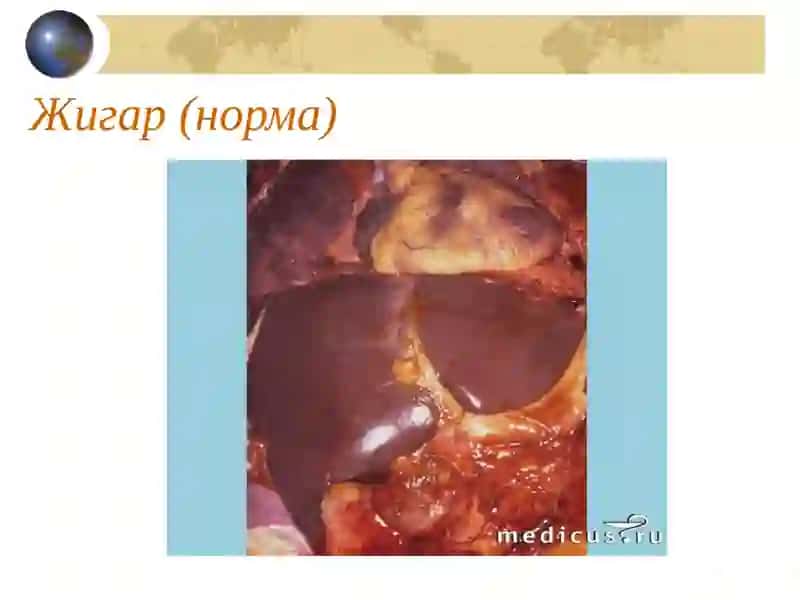 Сурункали гепатит 3