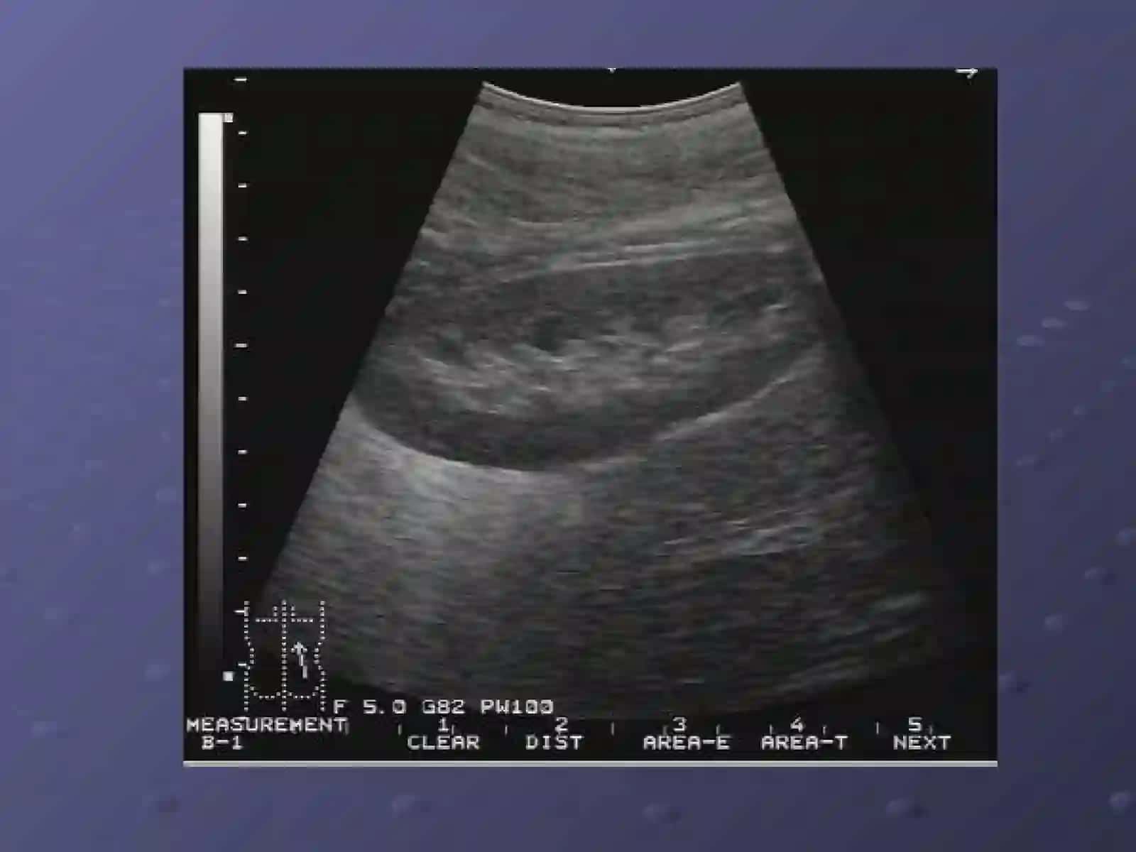 Buyrak va Siydik Yollari nur tashxisi Radiologiya 3