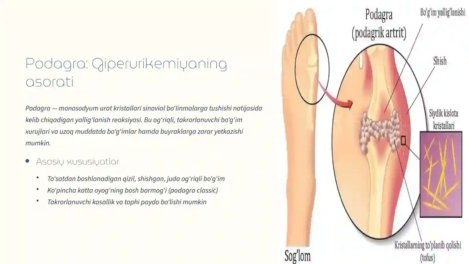 Giperurikemiya va podagra: Diagnostika va Zamonaviy Davolash Usullari 3