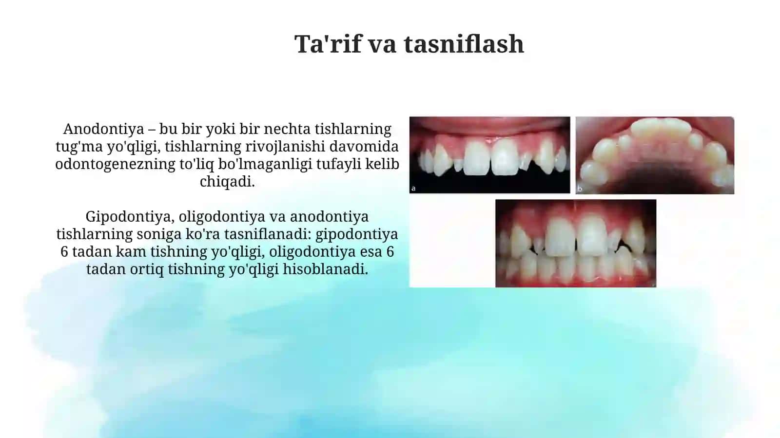 Tishlarning irsiy anomaliyalari (anodontiya, gipodontiya, makrodontiya,mikrodontiya) 3