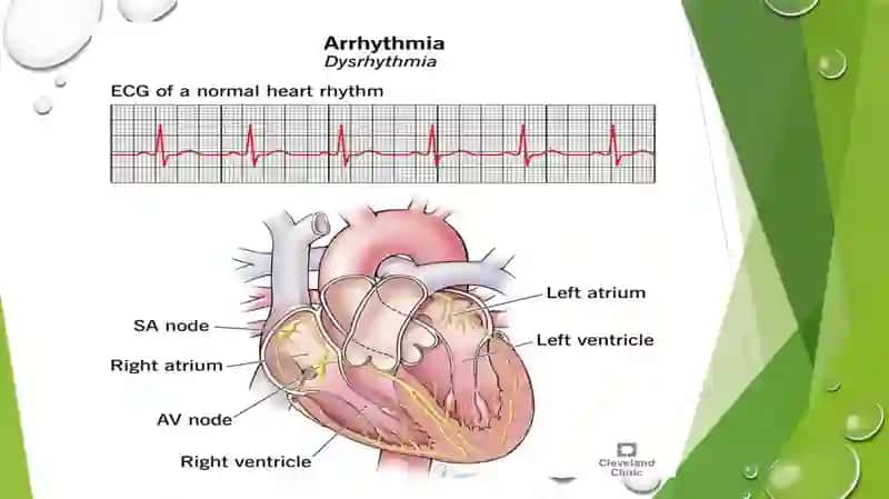 Yurak aritmiyalari EKG diagnostikasi 3