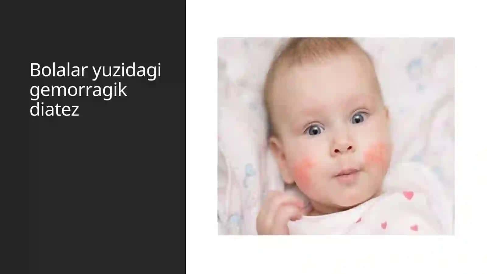 Gemorragik diatezlar 3