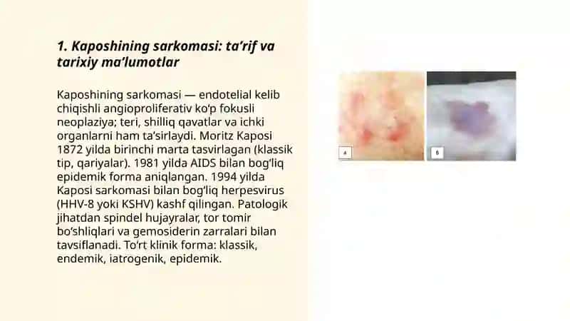 Kaposhining sarkomasi. Ekzema Kaposhi. IFA va PZR diagnostikusullarning dermatovenerologiyada qo‘llanilishi 3