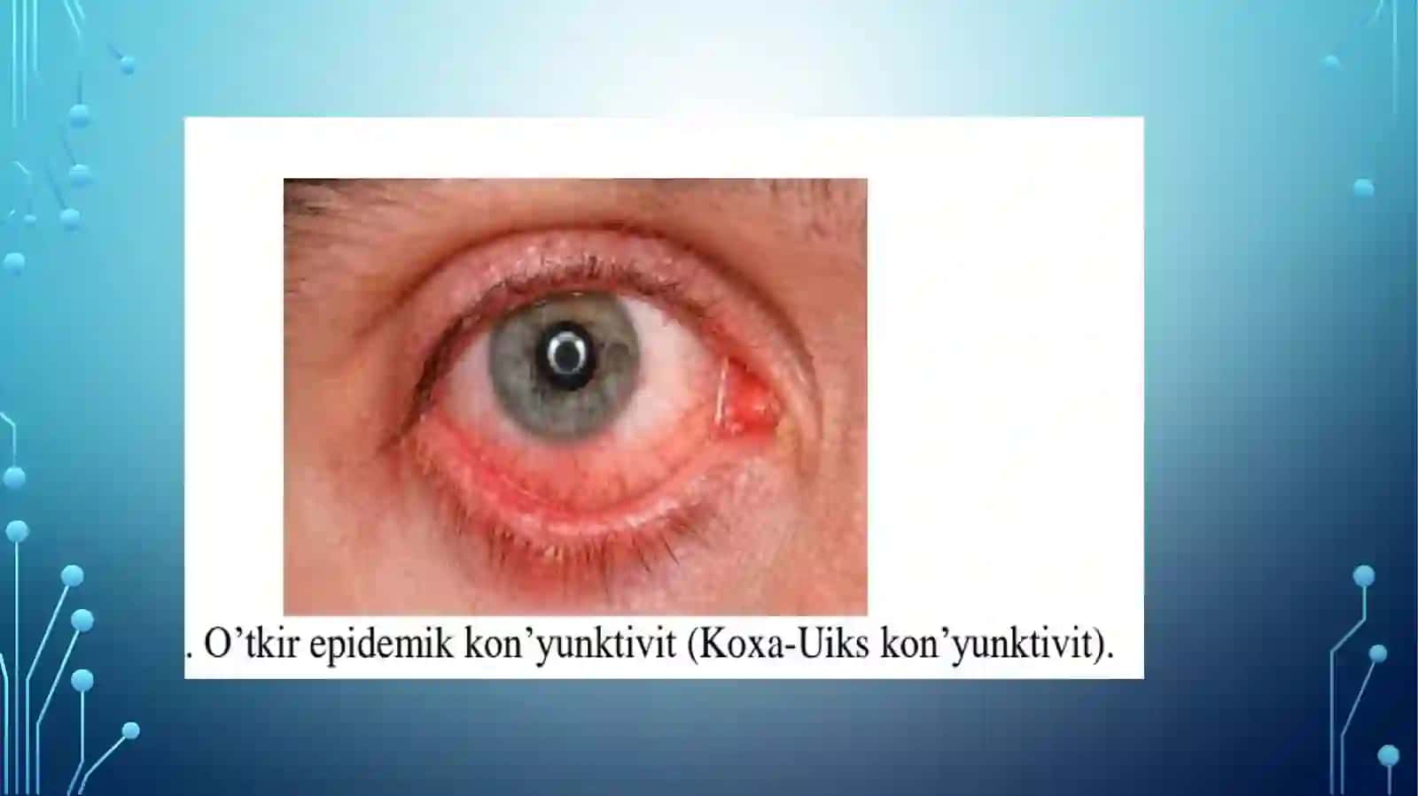 O’tkir epidemik kon’yunktivit(Koxa-Uiks kon’yunktiviti) 3