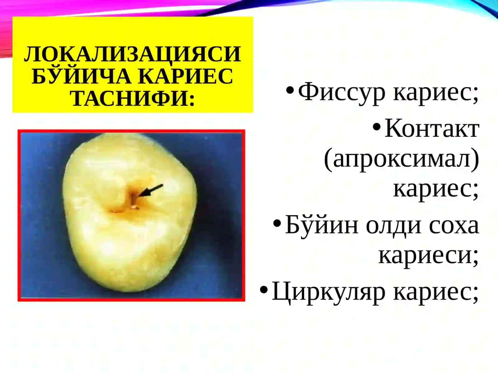 Хар ҳил босқичдаги кариес касалликларини клиникаси. Қиёсий ташҳиси. 3