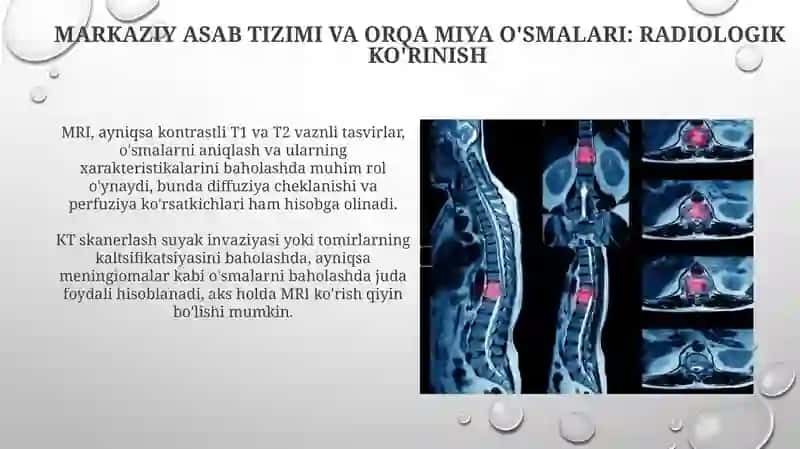 Markaziy nerv sistemasi va umurtqa o‘smalari(radiologiya faniga oid) 3