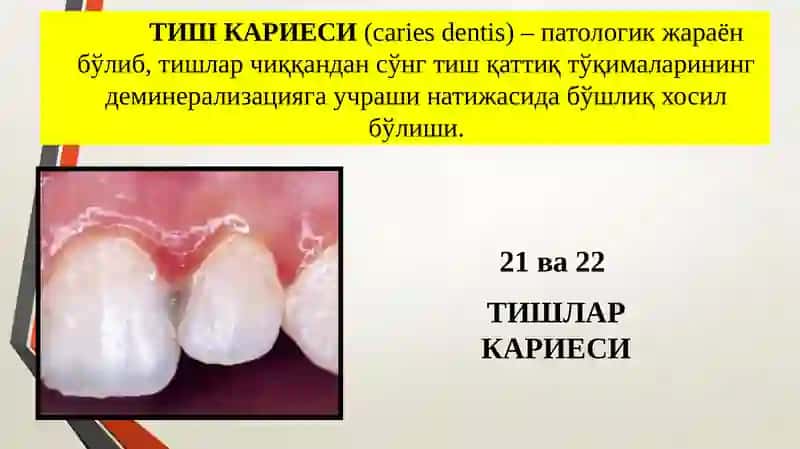 Кариес хақида тушунча. Кариес каваклари таснифи (Блэк бўйича). 3