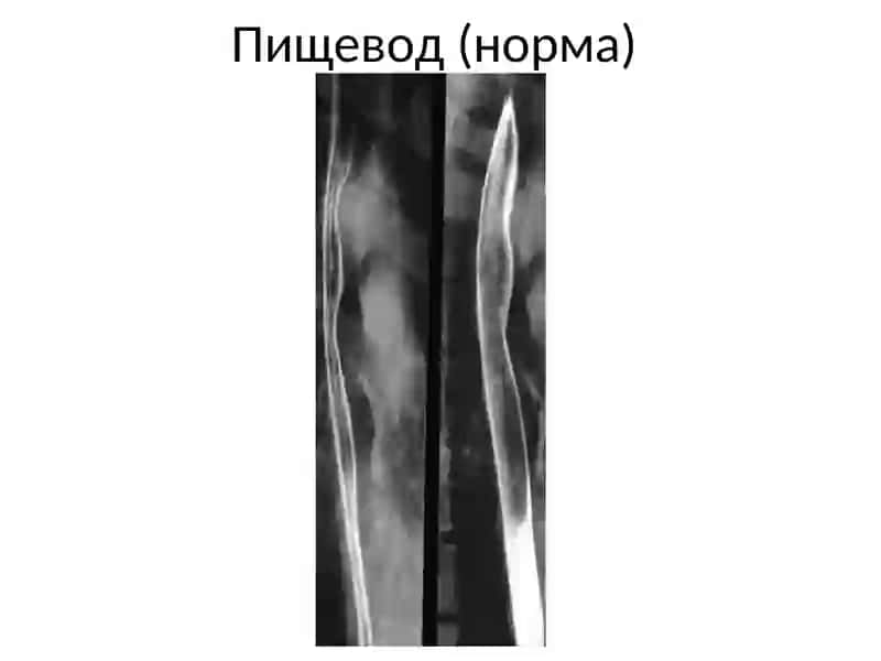 Желудочно-кишечный тракт 3