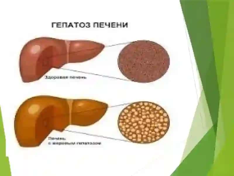 Гепатозы 3