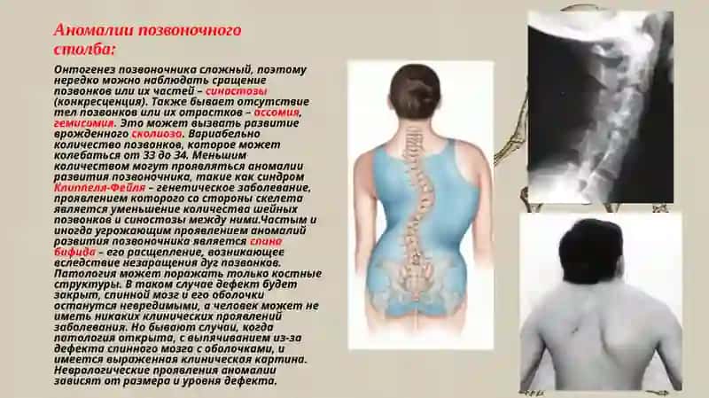 Аномалии скелета 3