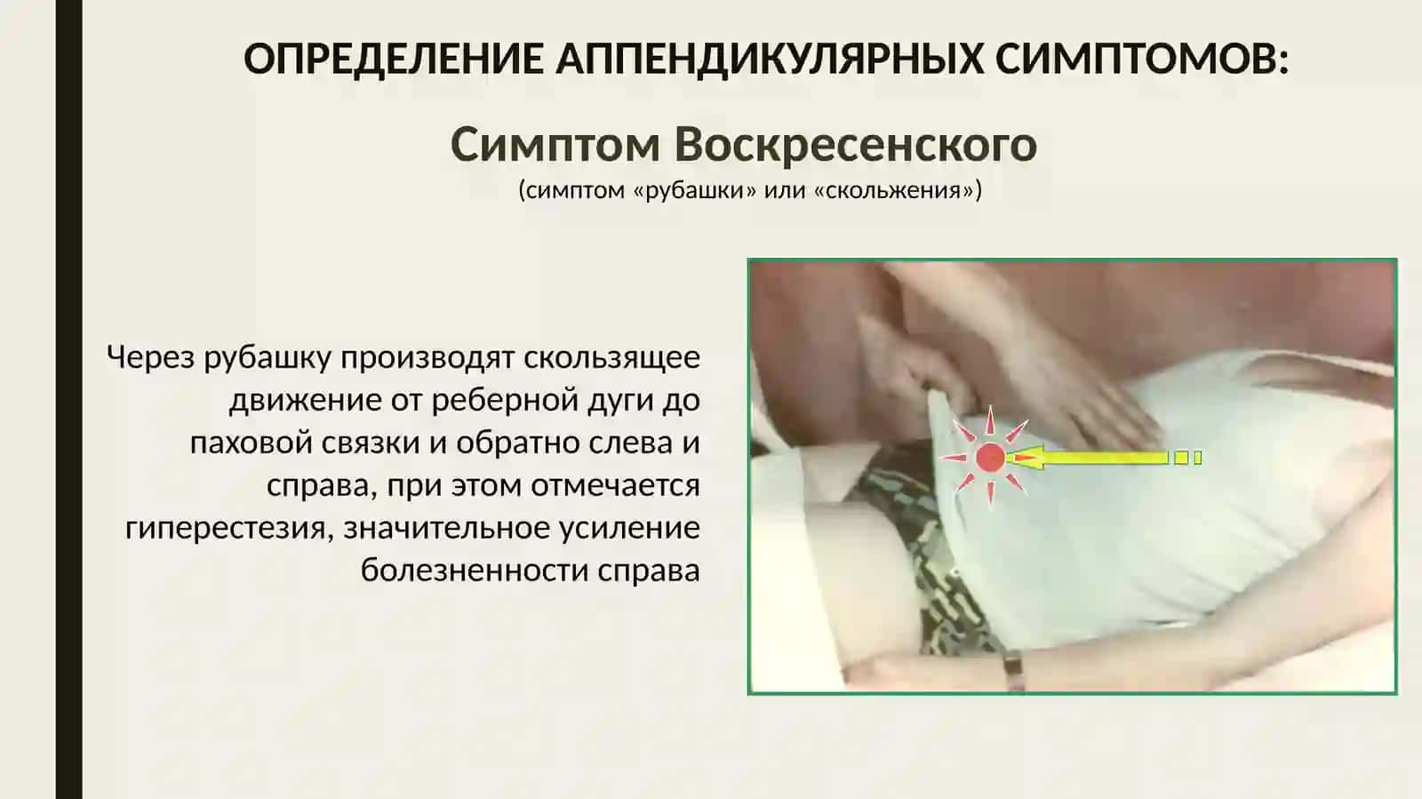 Ректальное исследование при тазовом аппендиците 3