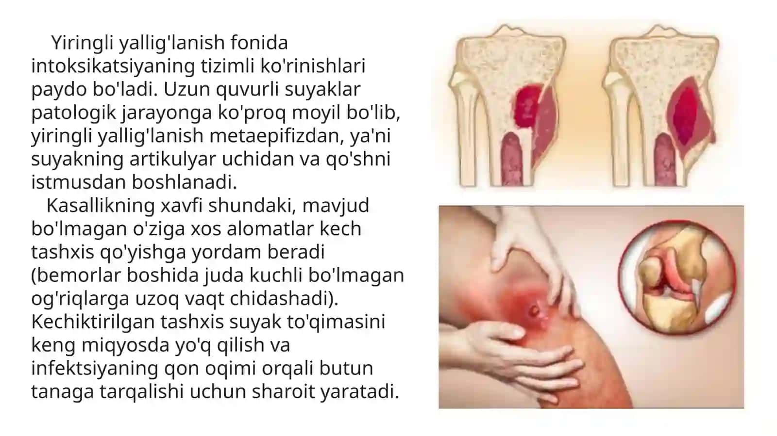 Gematogenli ostemielit 3