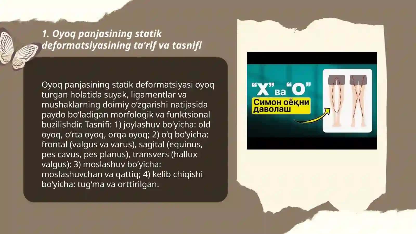 Oyoq panjasining statik deformatsiyasi 3