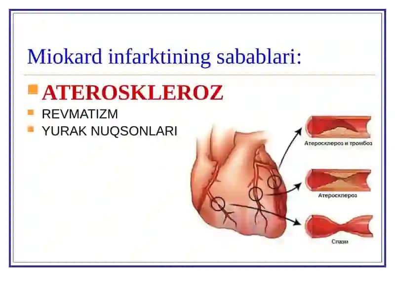 MIOKARD INFARKTI 3