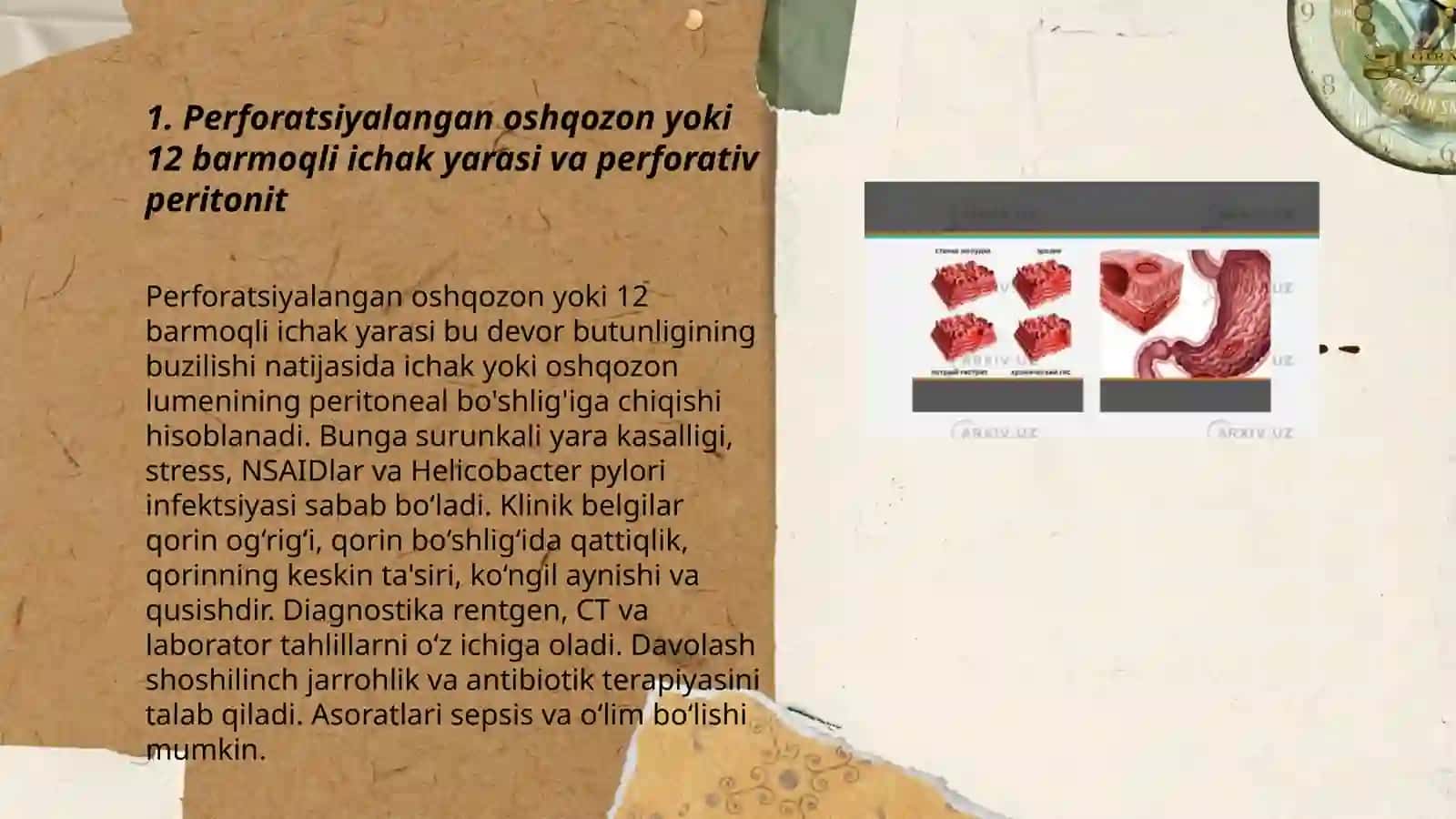 Oshqazon va 12 barmoqli ichak yara kasalligi asiratlari 3