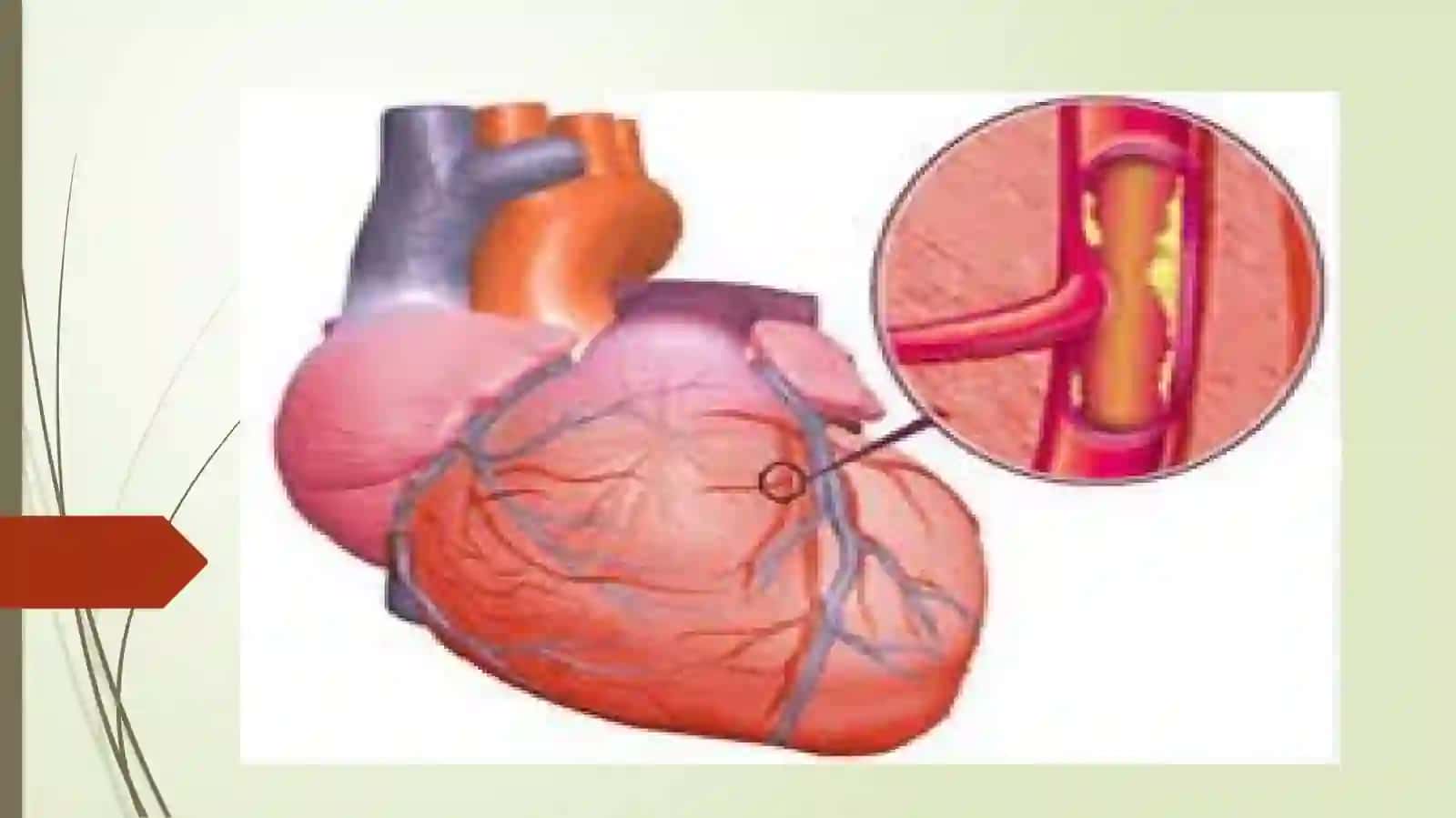 Obliterative endoarteritis, venous varicose expansion. Thrombosis and embolism 3