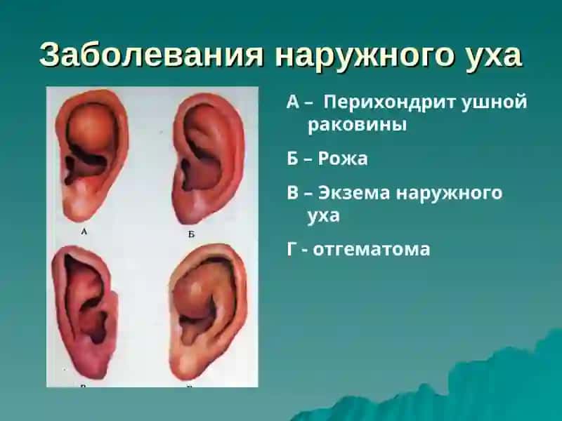 Этиология, патогенез, клиника, диагностика, лечение и профилактика воспалительных заболеваний уха 3