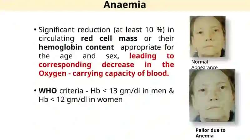 Anemia 3