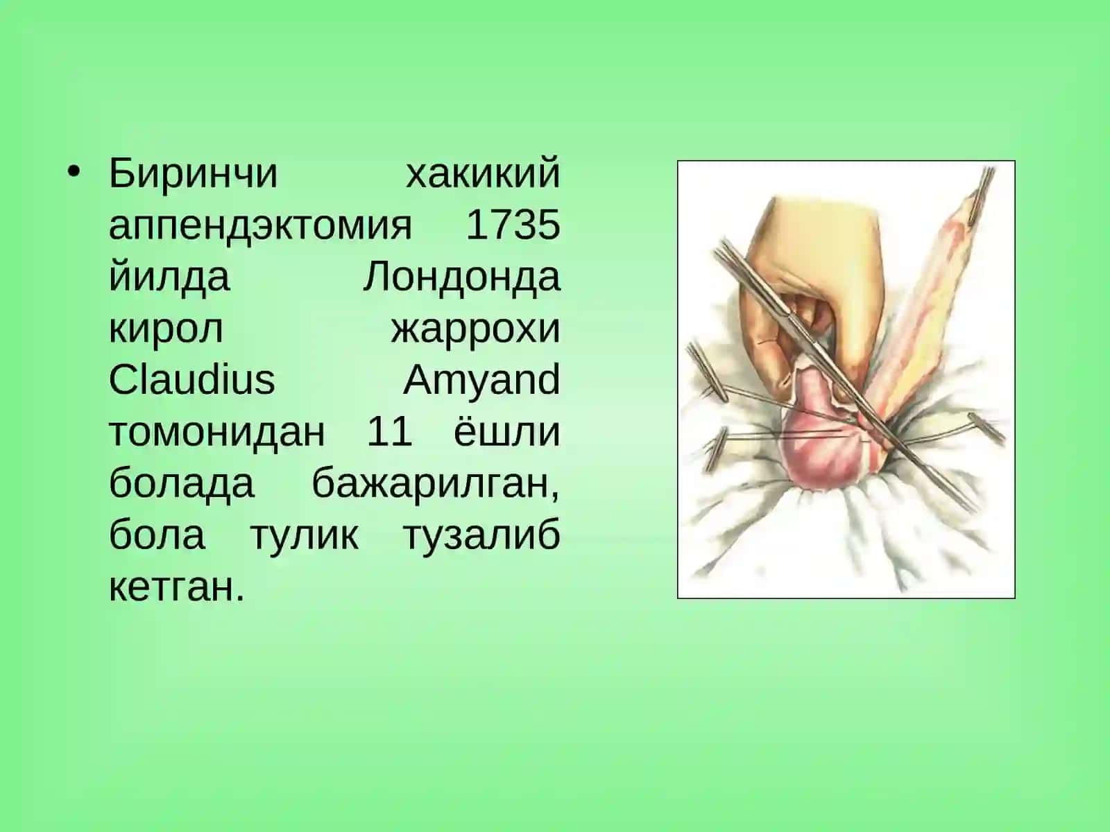 Ўткир аппендицит ва унинг асоратлари 3