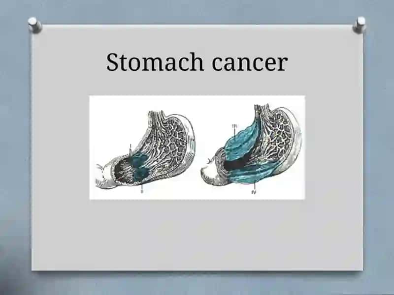 Stomach cancer 3