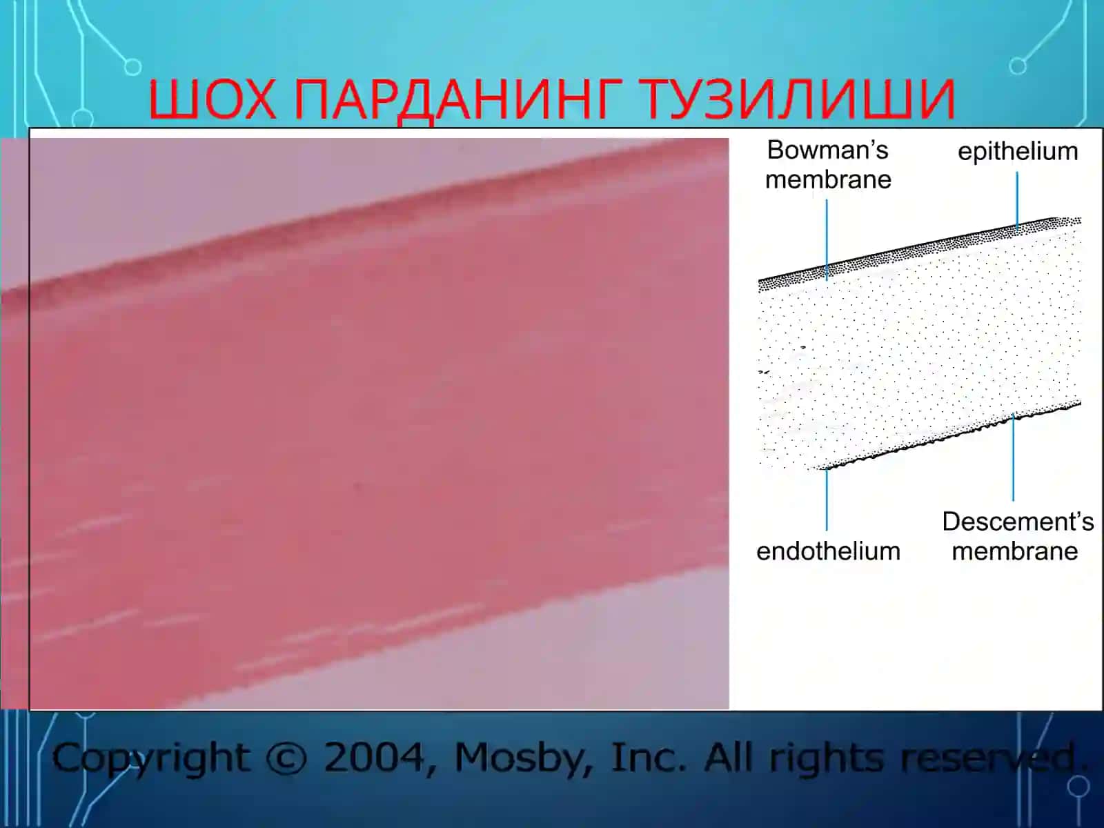 МЕГАЛОКОРНЕА 3