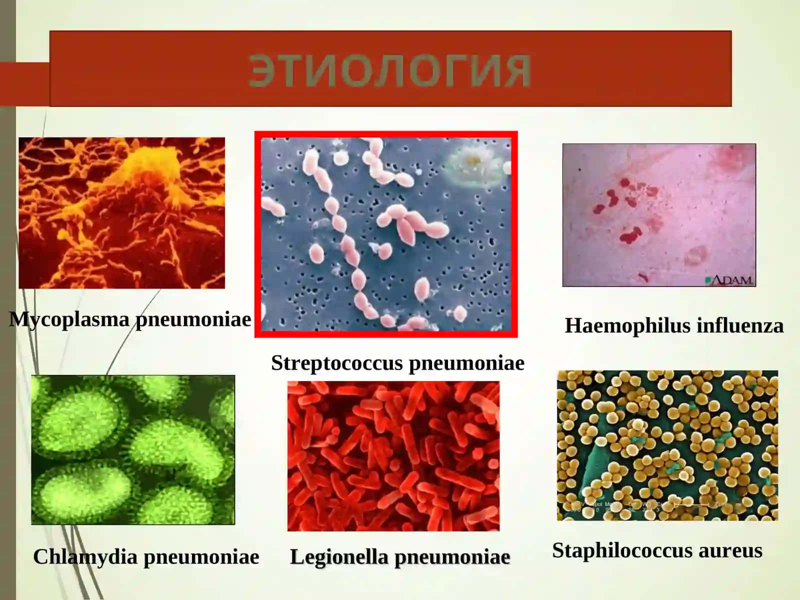 атипик пневмония 3