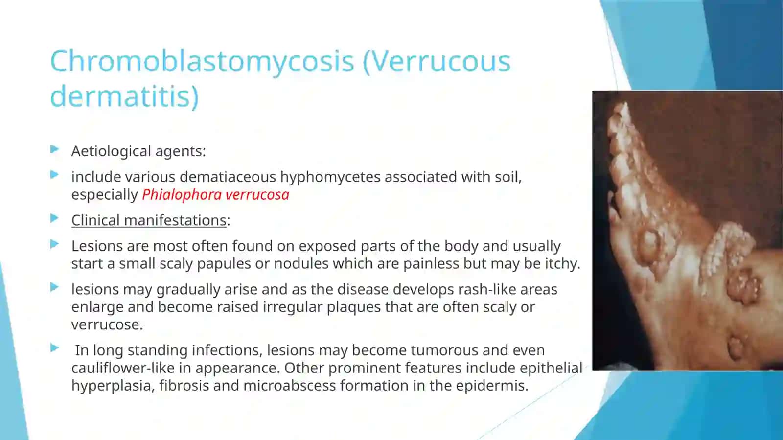 Subcutaneous mycoses 3