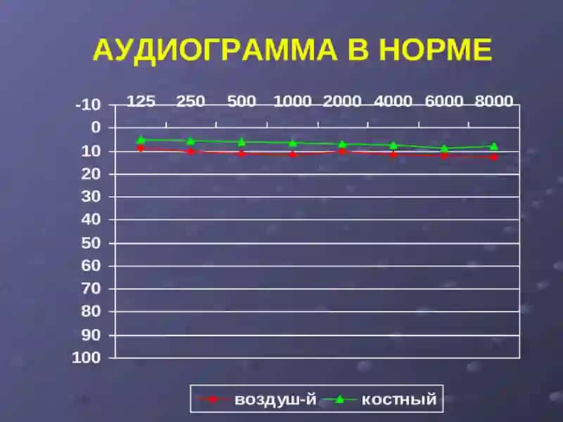 Болезнь Меньера 3