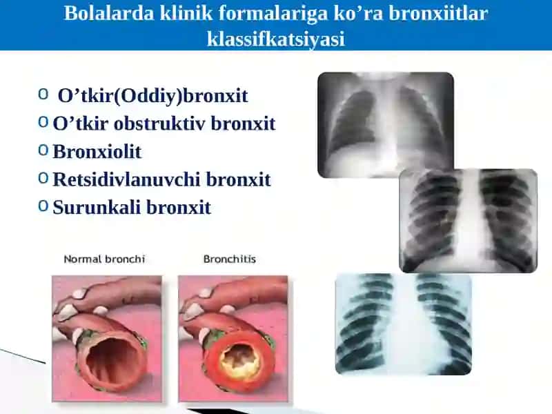 Bronxoobstruktiv sindrom 3
