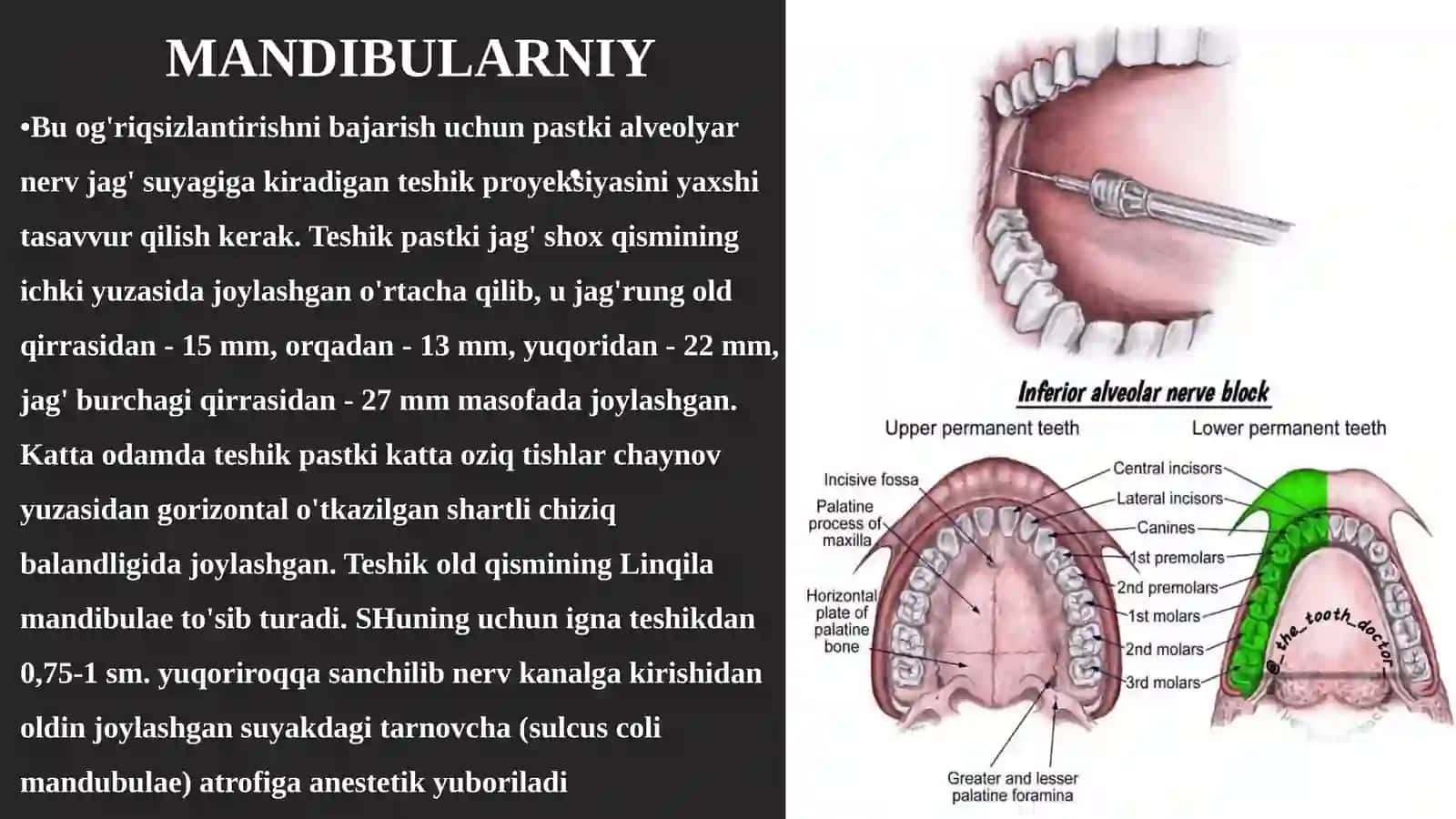 Stomatologiyada patstki jagʻda oʻtkaziladigan oʻrinsizlantirish haqida 3