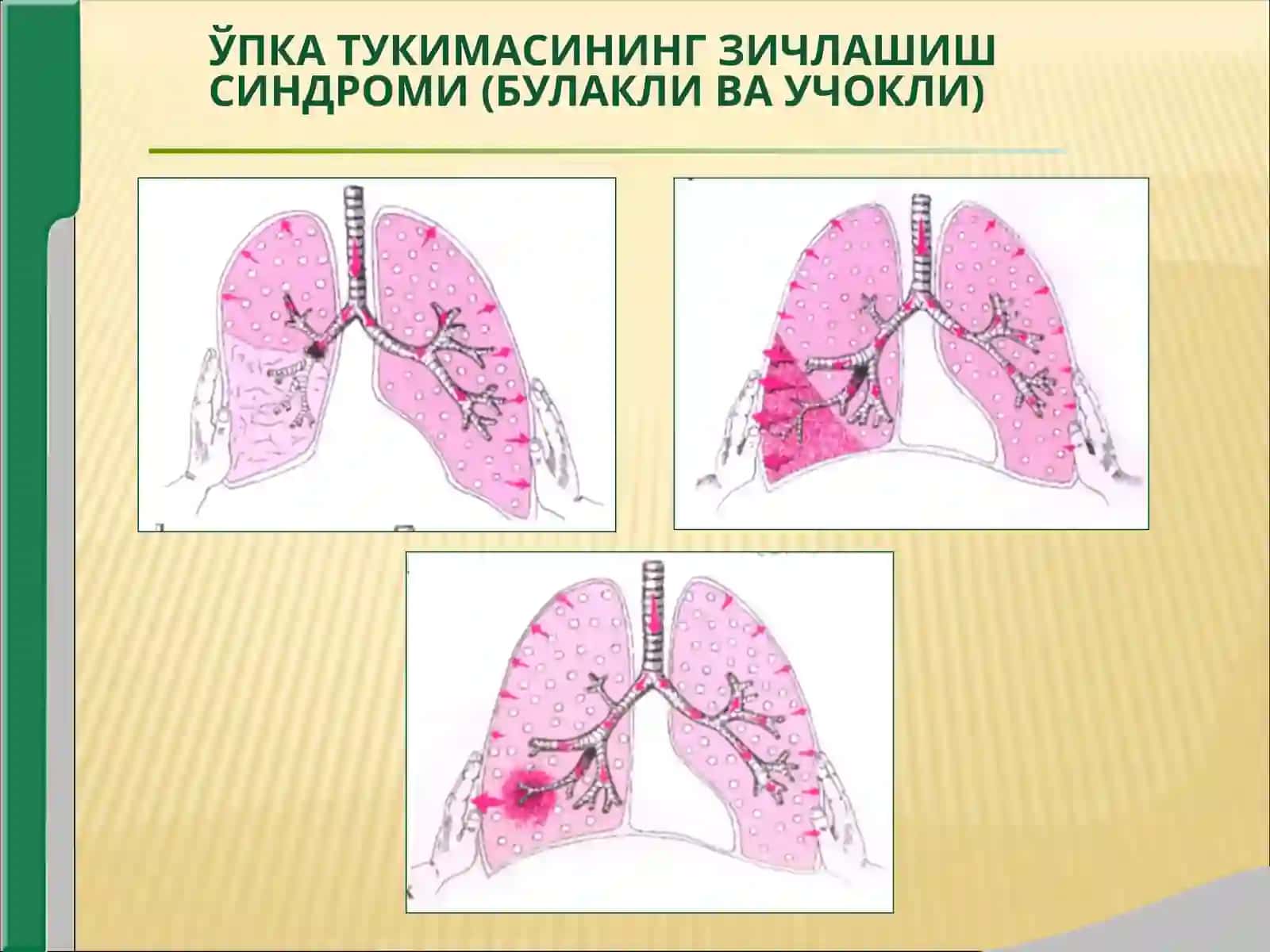 УПКА ТУКИМАСИНИНГ ЗИЧЛАШИШ СИНДРОМИ (БУЛАКЛИ ВА УЧОКЛИ) 3