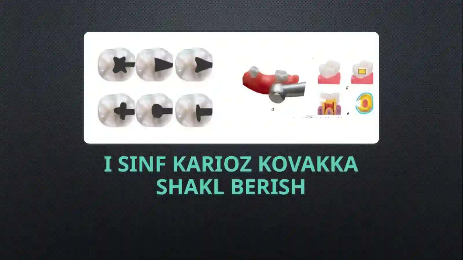 fantom xonalarda  vi sinf karioz bo'shliqlarga shakl berish va plombalash 3