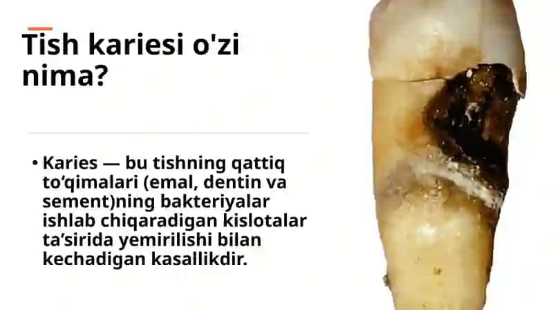 Kariesning etiologiyasi 3