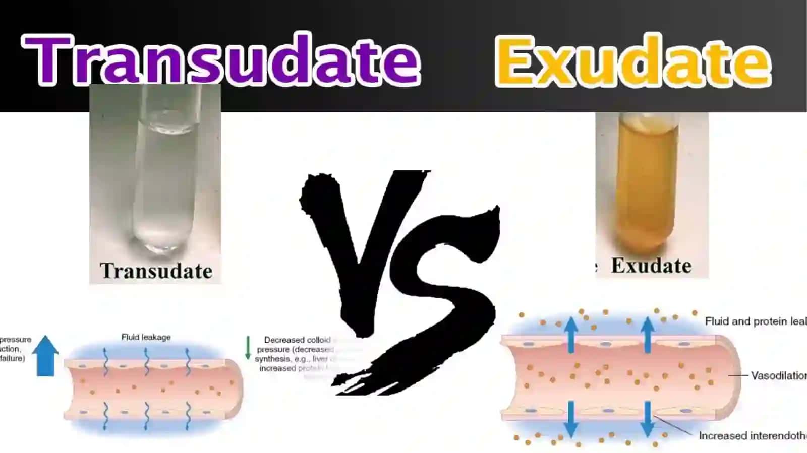 Plevral ekssudat asosida differensial diagnostika 3