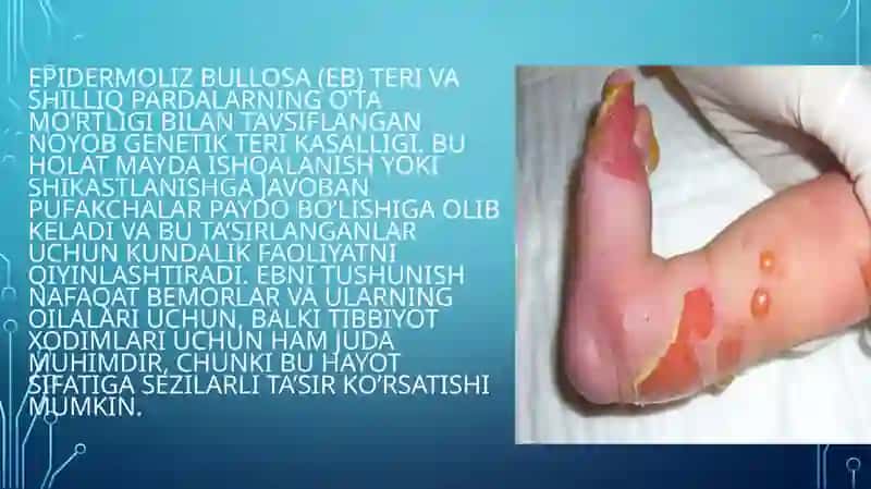 Bullyoz epidermoliz. Xeyli-Xeyli kasalligi. Chuqur mikozlar 3