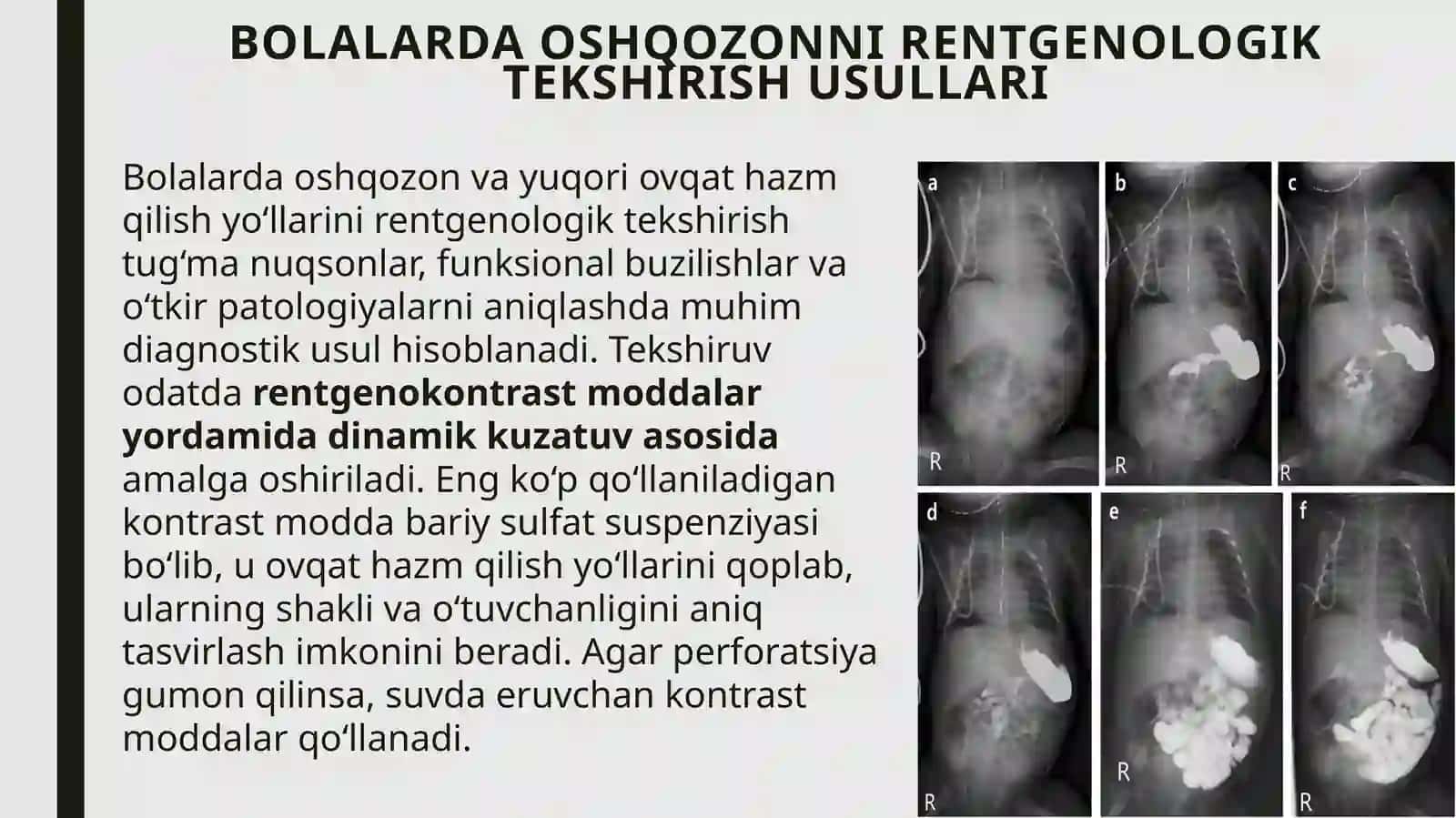 Bolalarda oshqozon kasalliklari: rentgenologik tekshiruv, anomaliyalar va kasalliklar 3